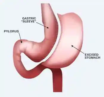 Gastric Sleve Diagram